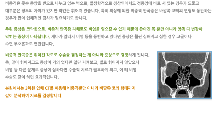 비중격 만곡증
