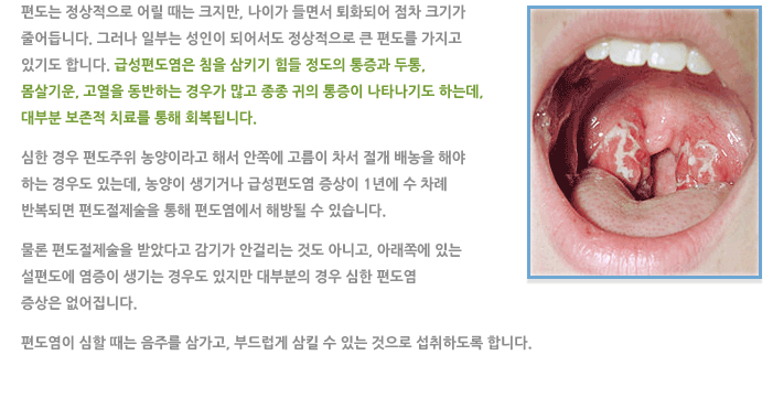 급성편도염