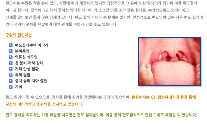 편도결석 및 구취(입냄새)