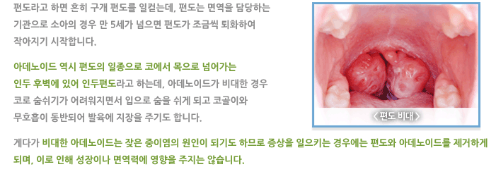 편도 및 아데노이드 비대