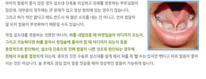 설소대 단축