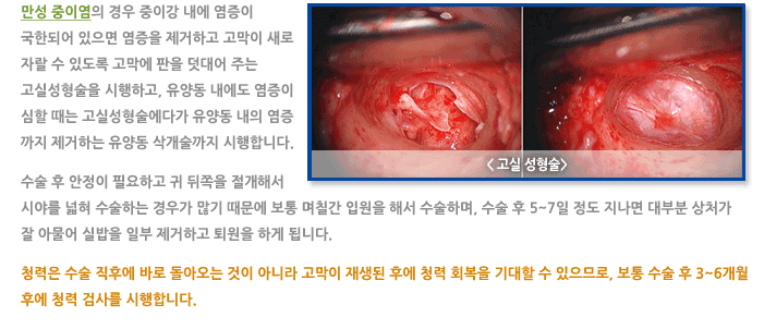 중이염 수술