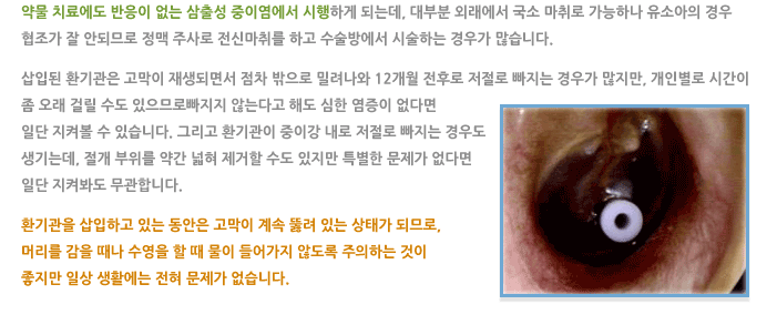 중이 환기관 삽입술