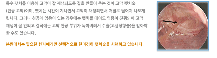 고막 팻치술(인공고막)