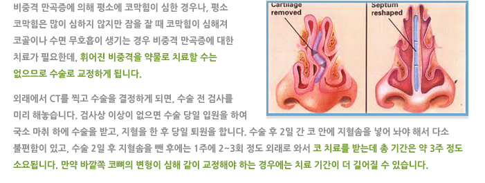 비중격 교정술