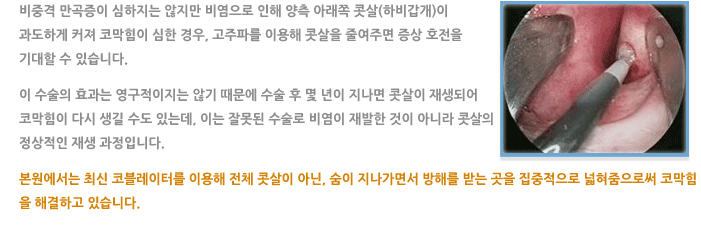 고주파 비염수술