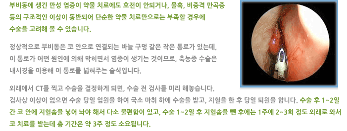 내시경 축농증 수술