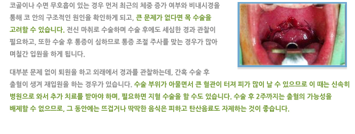 코골이/수면무호흡수술