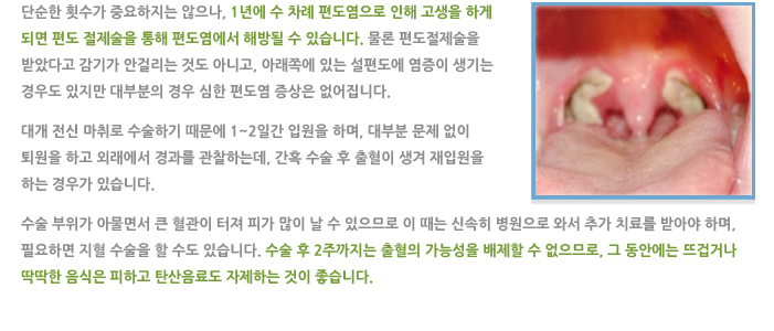 편도선 절제술