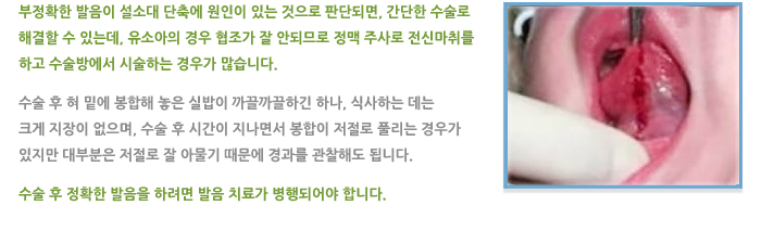 설소대 절개술