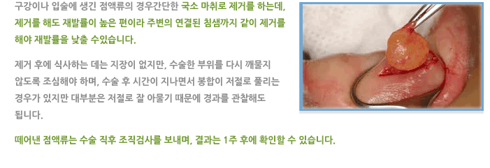 구강/입술 종물 제거술